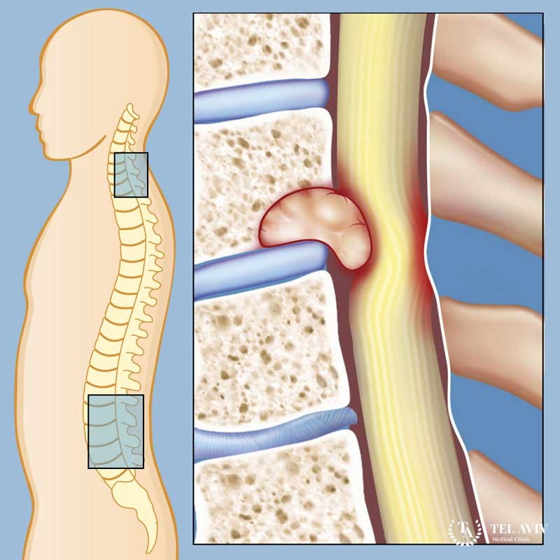 Опухоли спинного мозга, позвоночника