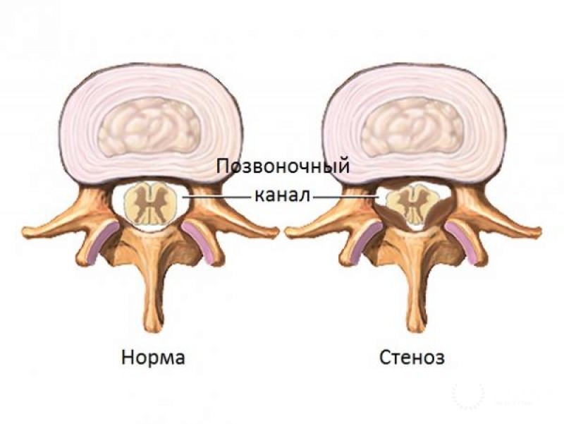 Стеноз позвоночного канала