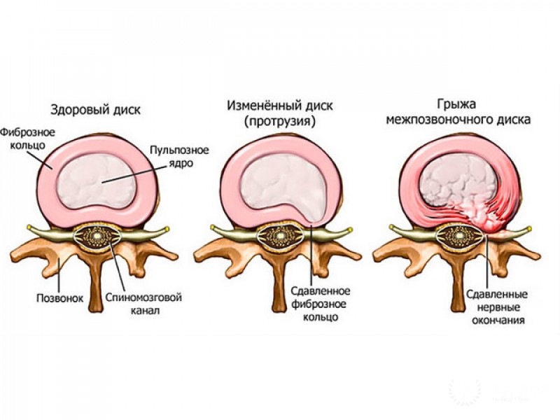 Грыжи межпозвоночного диска