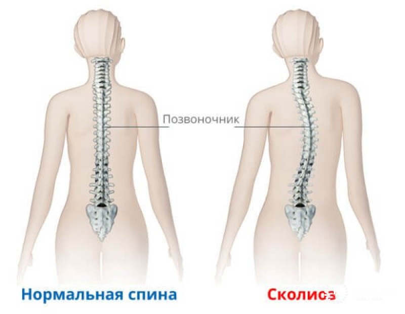 Сколиоз – симптомы, диагностика, лечение