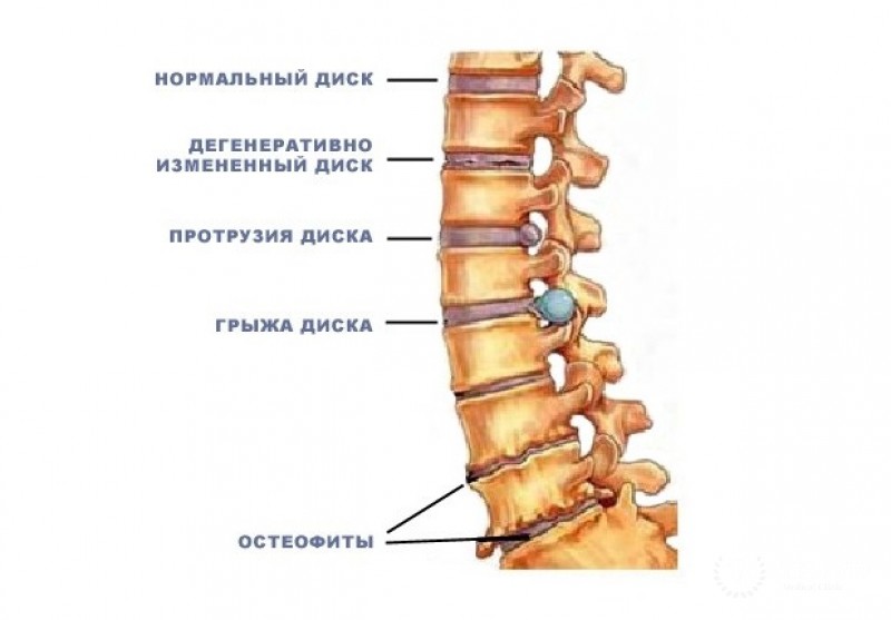 Дегенеративные заболевания позвоночника
