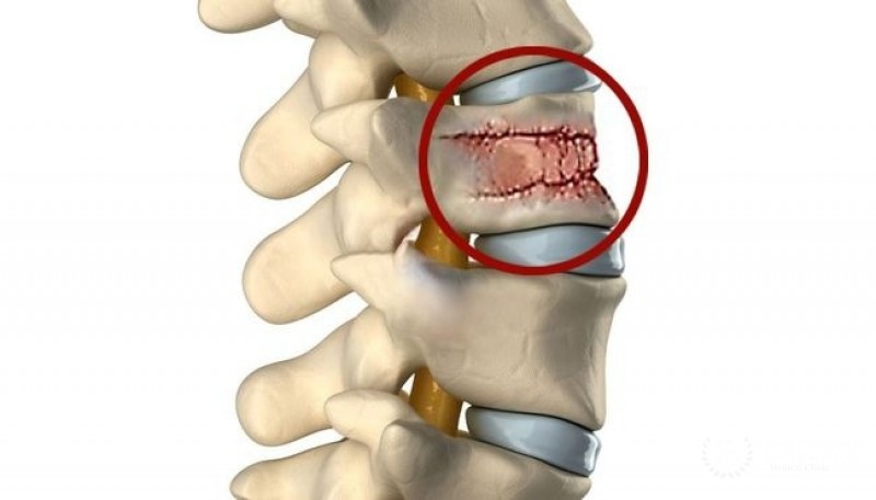 Виды перелома позвоночника