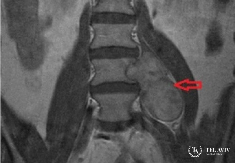 Невриномы спинного мозга и позвоночника – симптомы, диагностика, лечение