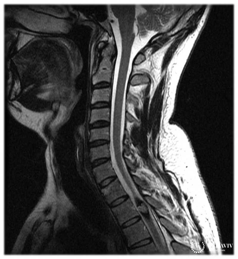Кавернома сосудов спинного мозга – признаки, диагностика, лечение
