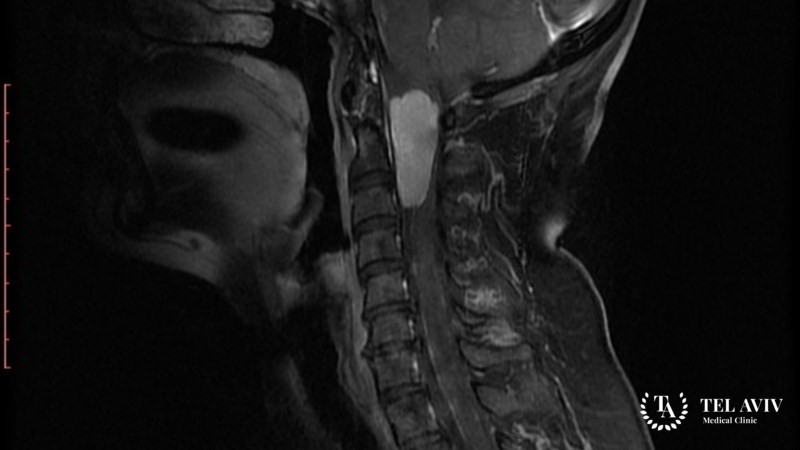 Менингиома спинного мозга и позвоночника – симптоматика, диагностика, лечение