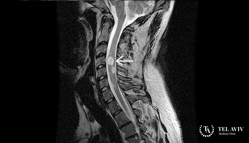 Астроцитома спинного мозга - диагностика и симптоматика