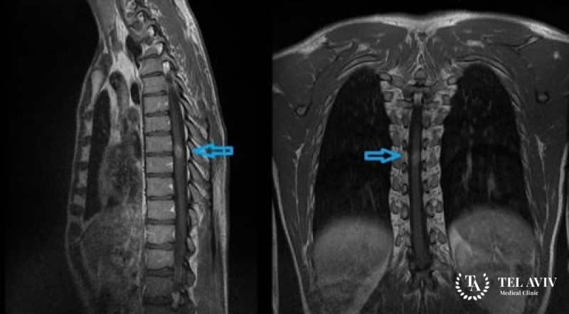 Истинная эпендимома - симптоматика и лечение