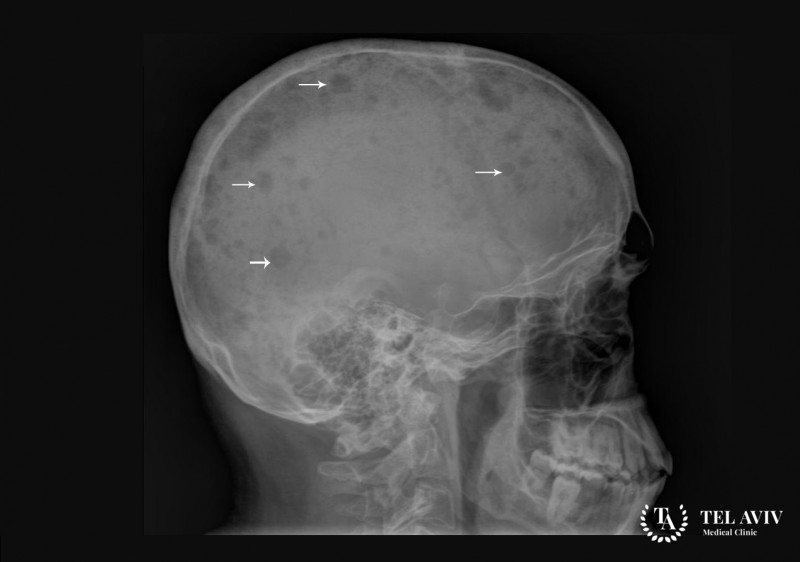 Плазмоцитома