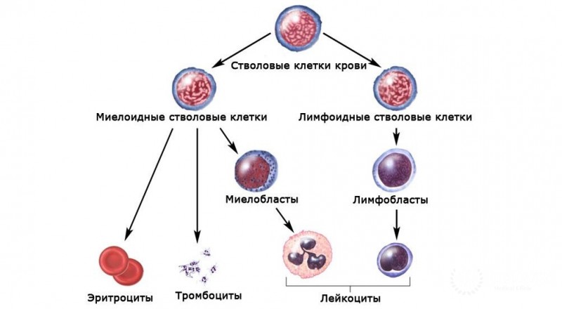 Острый миелоидный (гранулоцитарный) лейкоз