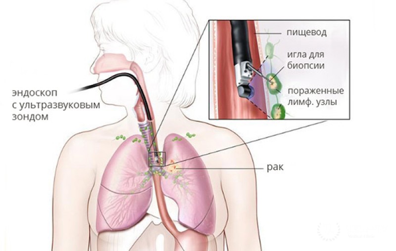 Биопсия лимфатических узлов средостения
