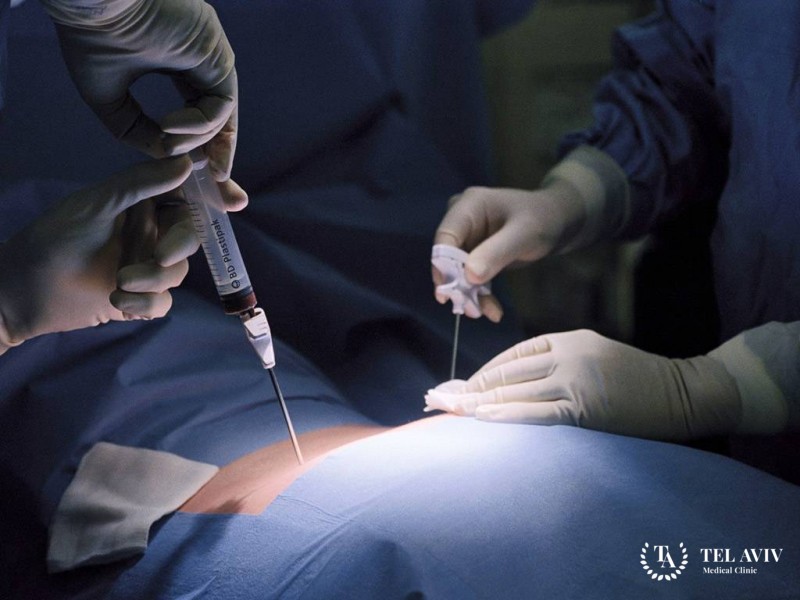 Пересадка стволовых клеток