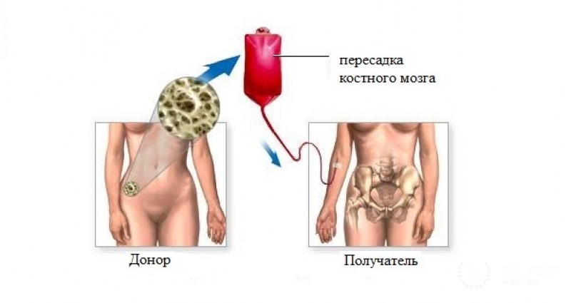 Пересадка костного мозга