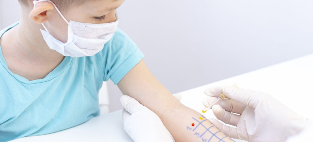 Allergen test on hand. child undergoing procedure of allergen skin test in clinic.