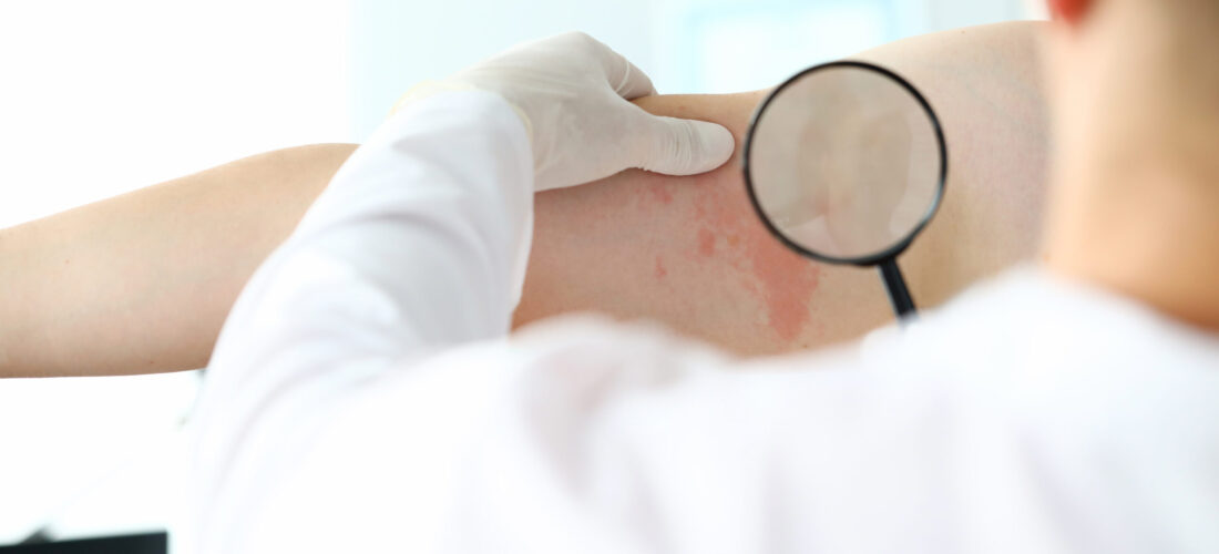 Male doctor in white protective gloves hold magnifying glass. Examines patient with skin disease against office background. Allergy treatment concept